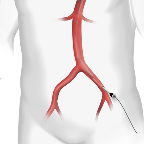 Transfemoral Carotid Artery Stenting (TF-CAS)