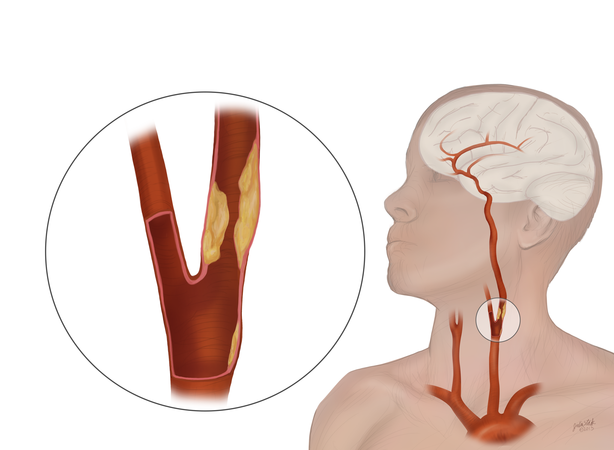 Diagnosing Carotid Artery Blockage