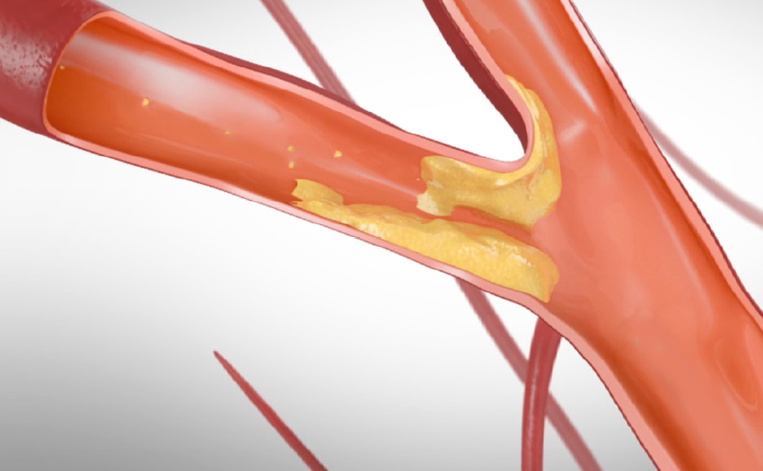 Carotid Artery Disease Stenosis and Blockages