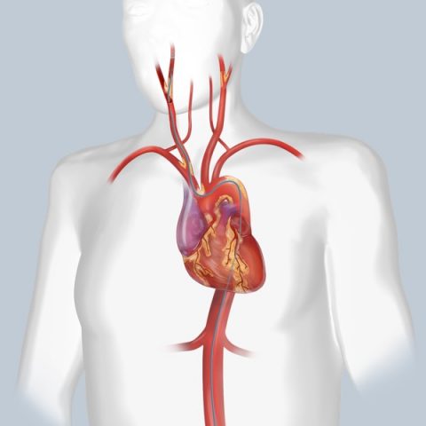 Treatment Type Transfemoral Carotid Artery Stenting Protection From