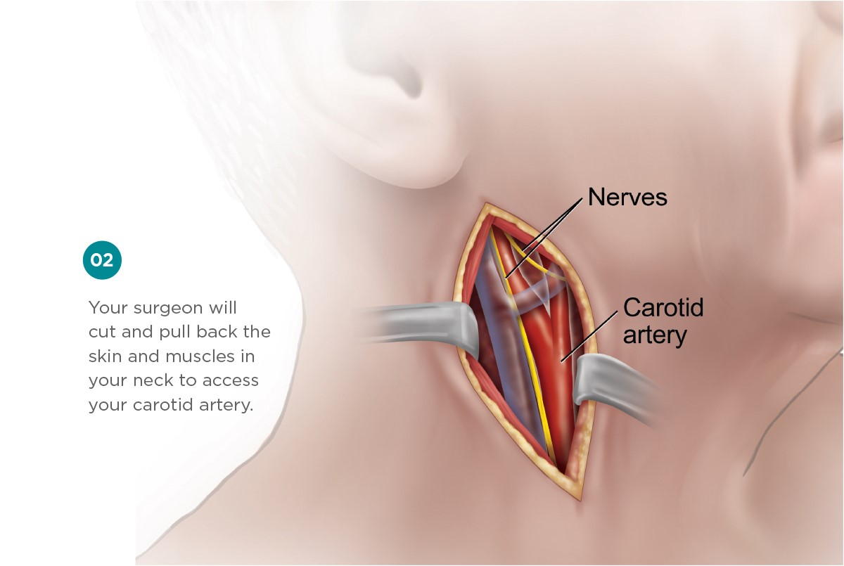 severed carotid artery in brain