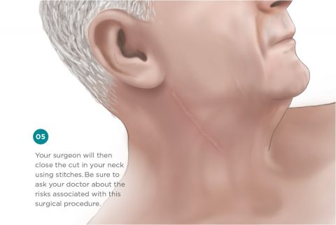 Carotid Endarterectomy Information